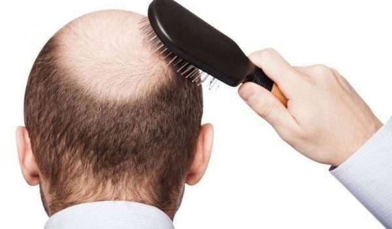 هل يتسبب كورونا في تساقط الشعر؟